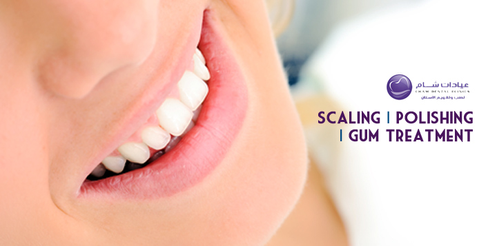 Teeth Scaling and Polishing