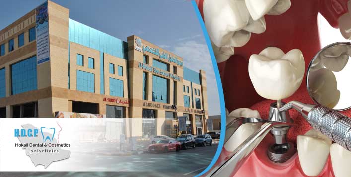 مجانا خصم 60 على جميع خدمات طب الأسنان كوبون صفقات