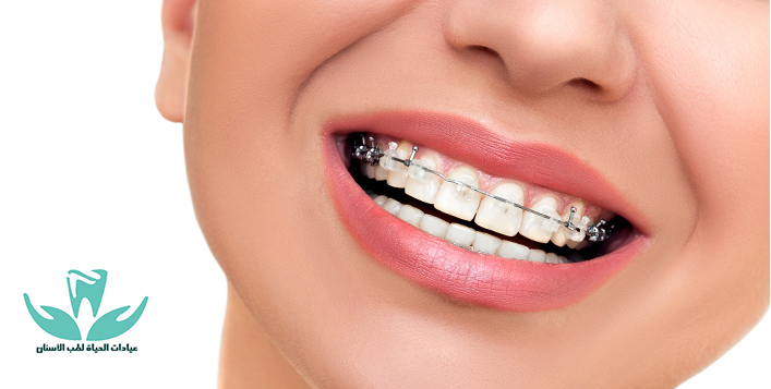Orthodontic braces from Life Clinic