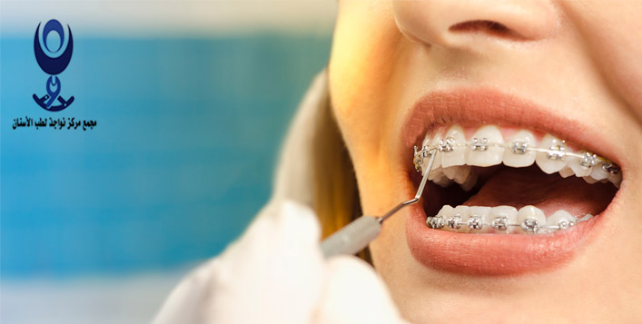 عروض مميزة على تركيب تقويم الاسنان في مجمع مركز نواجذ لطب الاسنان كوبون
