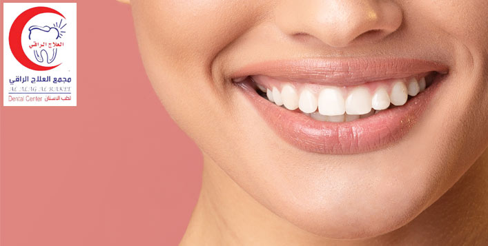 Teeth whitening or Hollywood snap-on smile!
