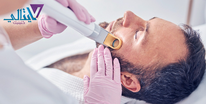 Beard line laser Clearance