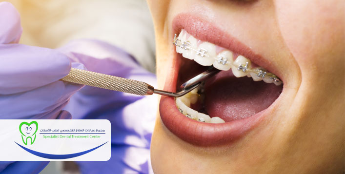 جلسة تركيب تقويم أسنان كوبون