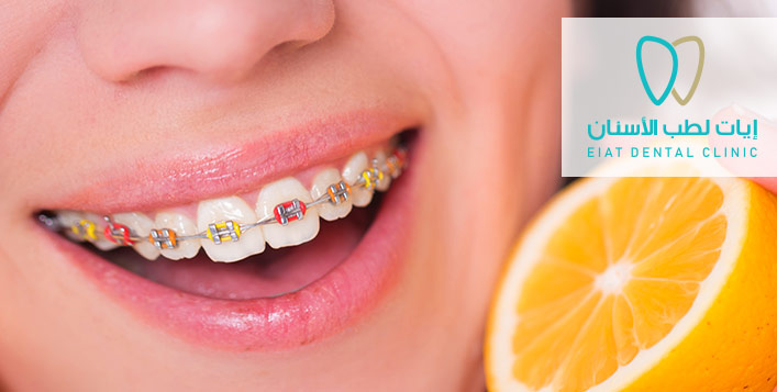 تقويم زينة غير طبي للفكين كوبون