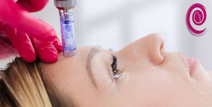 Derma Pen Session For Face | Cobone