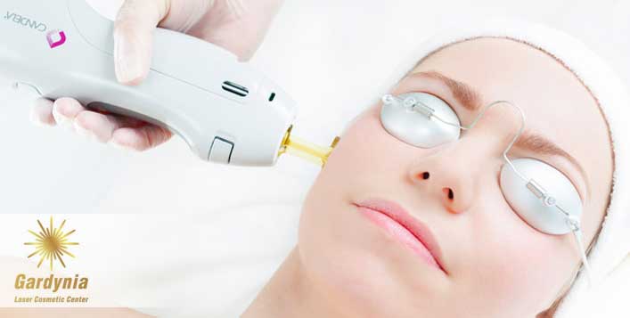 Laser Hair Reduction And Beard Shaping Cobone Offers